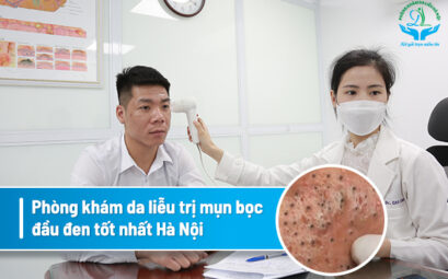 Hướng dẫn cách trị mụn trứng cá tuổi dậy thì
